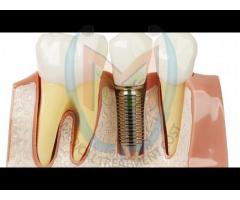Single implant along with Crown at Perfect Dental Care in Mumbai